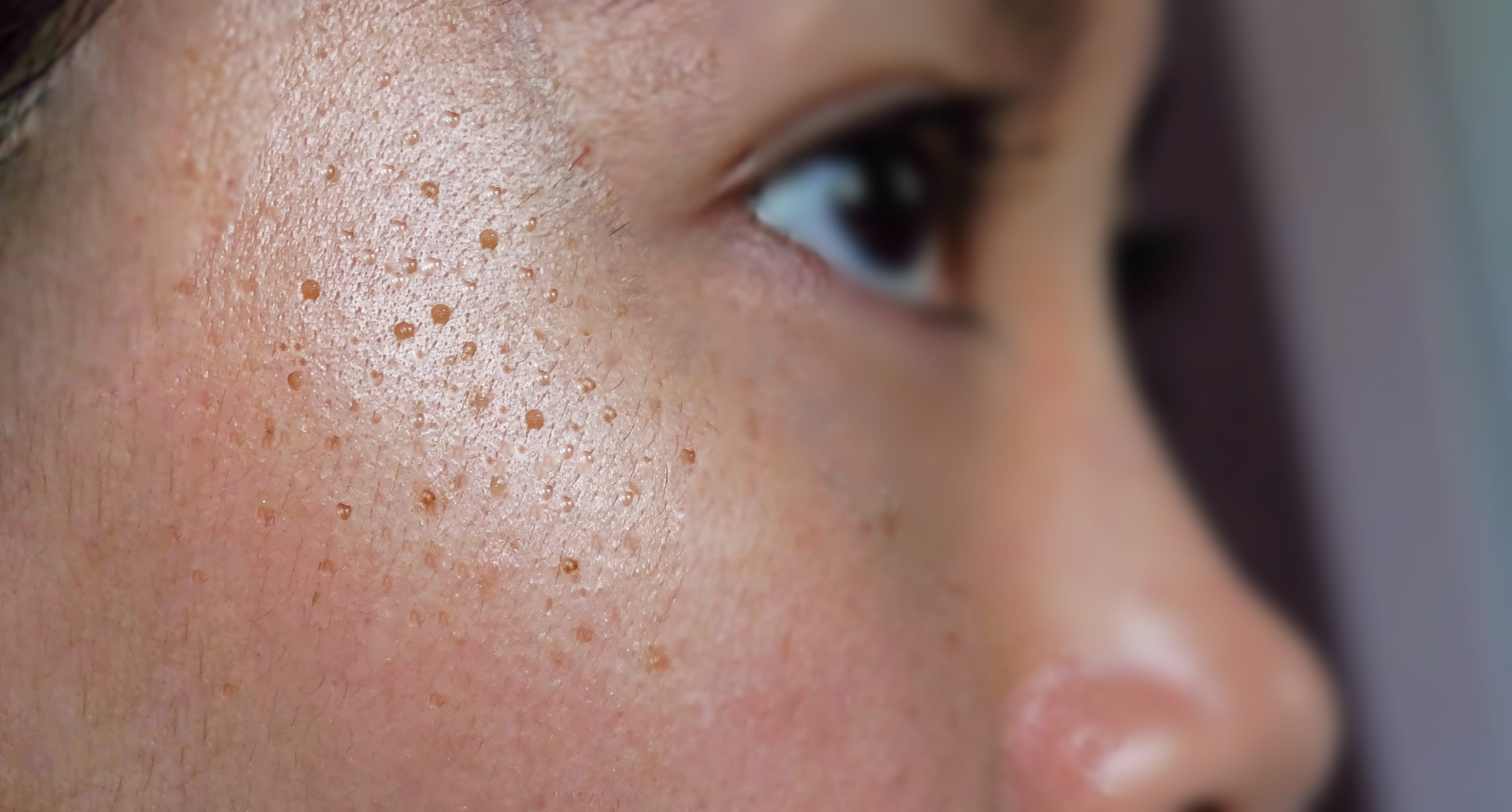 Hyperpigmentation, dark spots on the skin and natural remedies